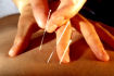 Acupuncture Formulas