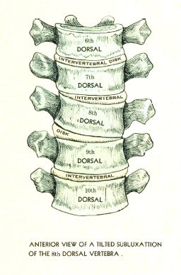 Spinal Nerves and Subluxations Poster