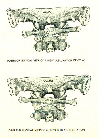 Spinal Nerves and Subluxations Poster