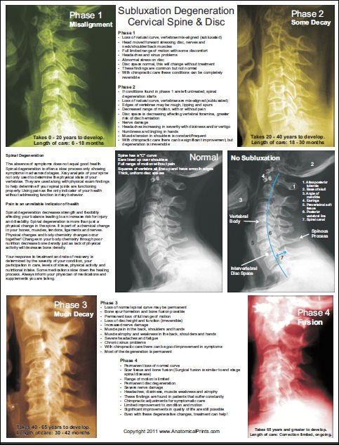 Subluxation Degeneration Poster