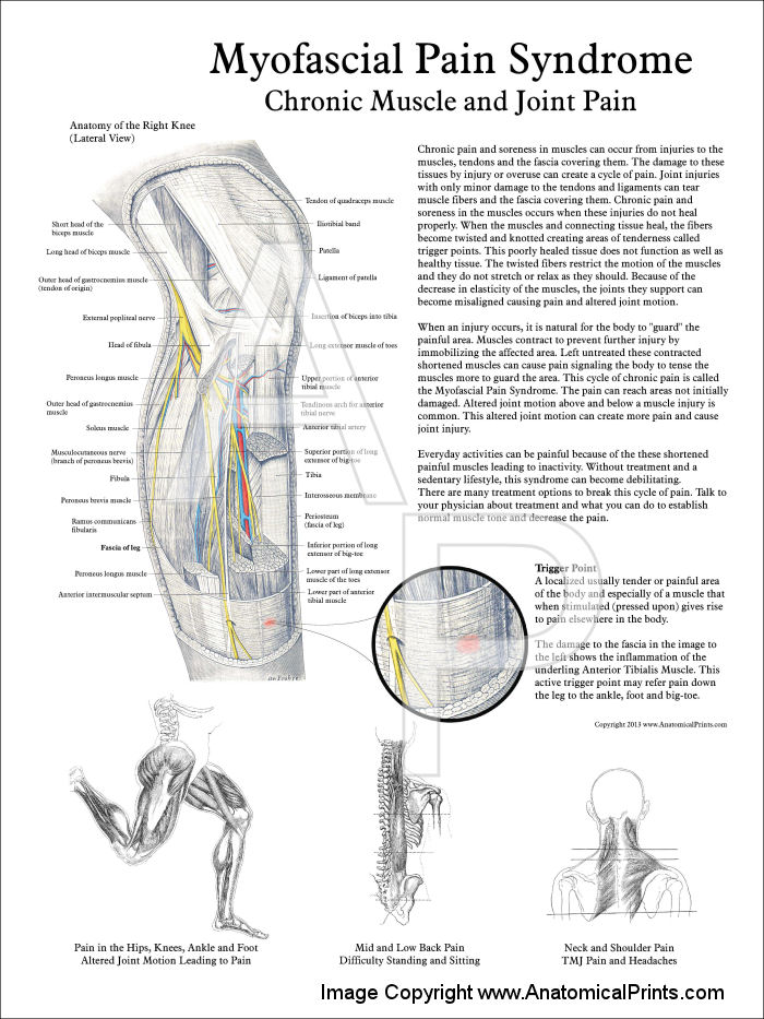 Myofascial Pain Syndrome Poster