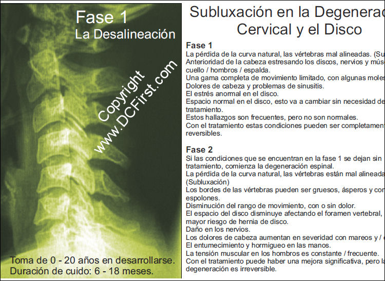 Subluxation Degeneration Poster