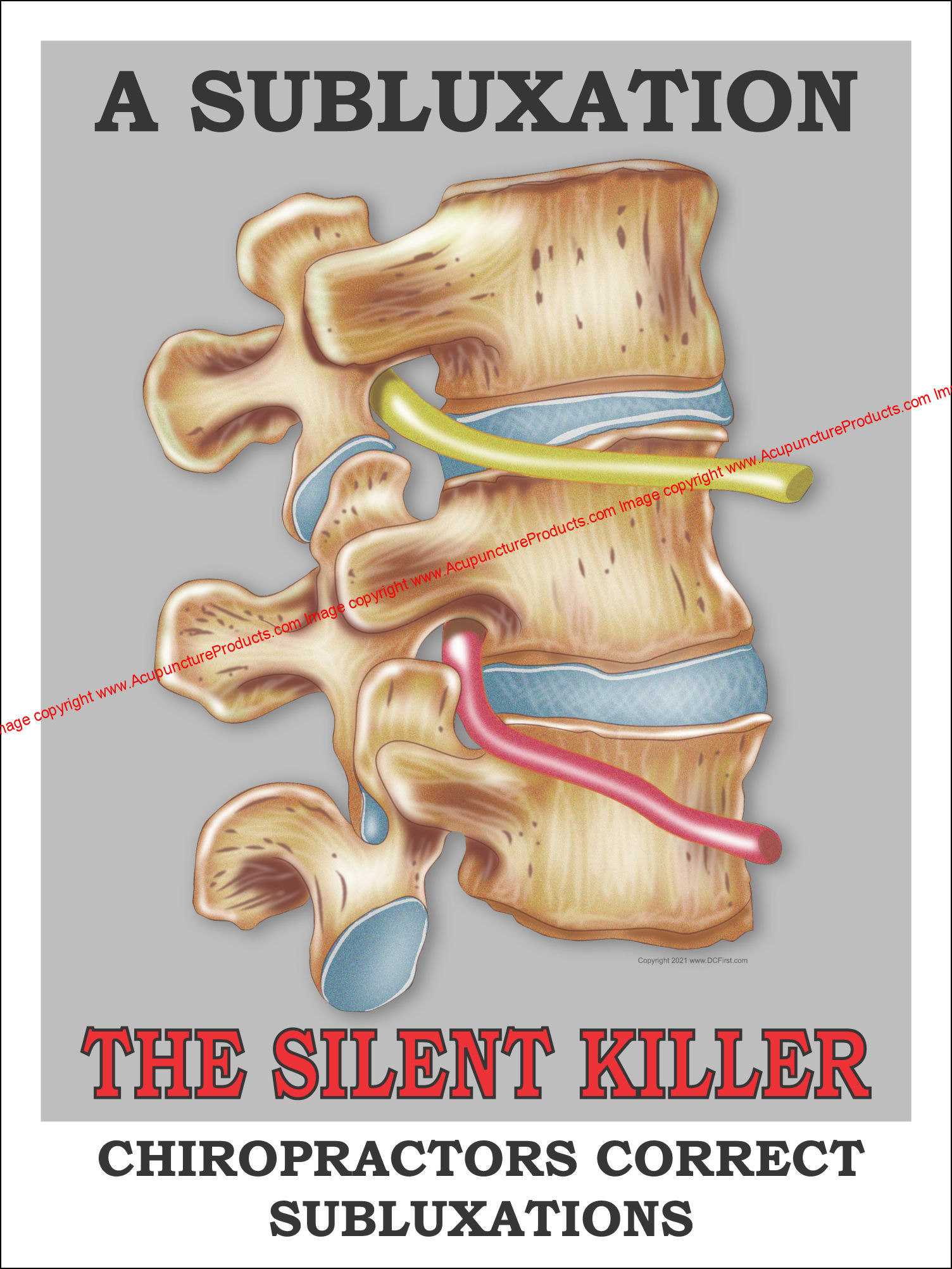 A Subluxation The Silent Killer Poster