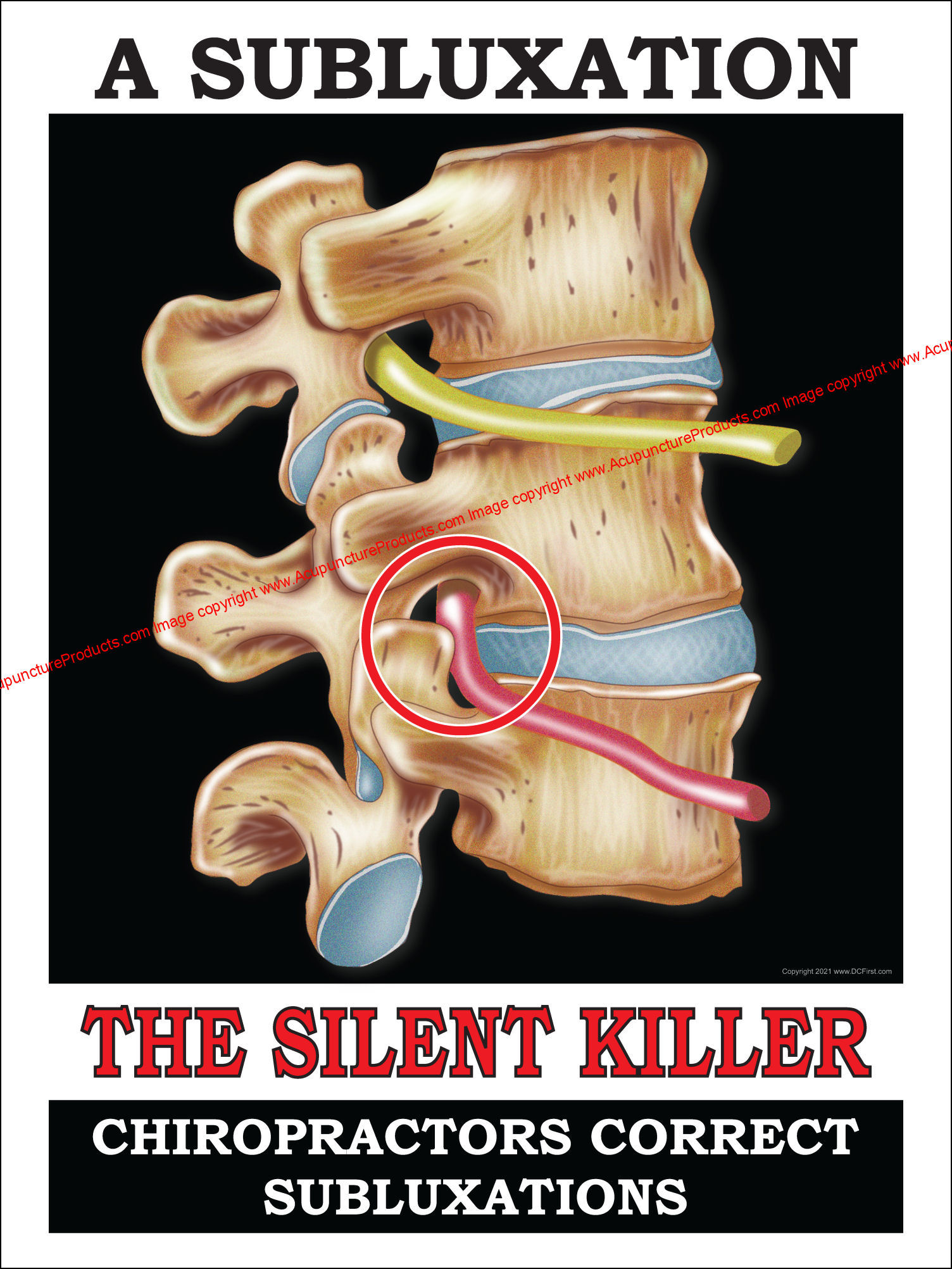 A Subluxation The Silent Killer Poster