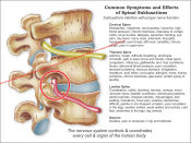 Chiropractic Subluxation Poster