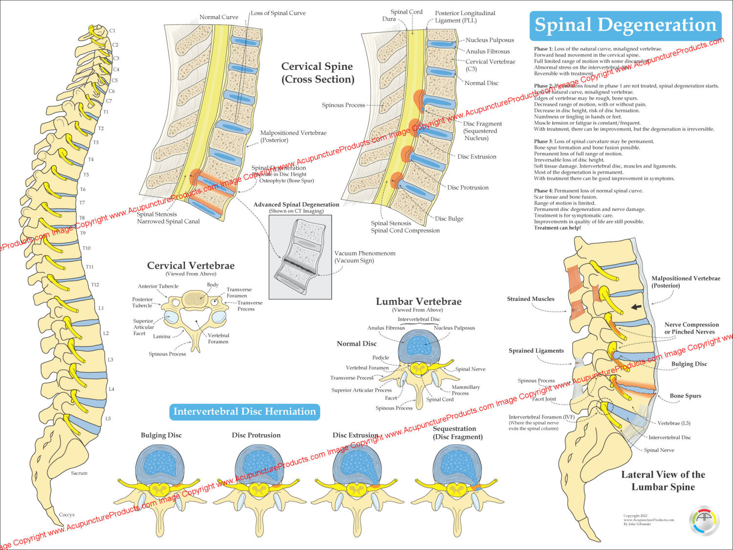 Spinal Degeneration Poster