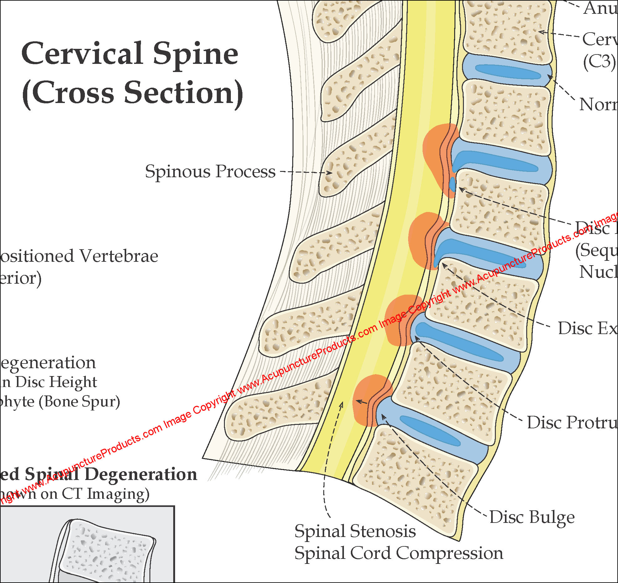 Cervical Vertebral Disc Herniation