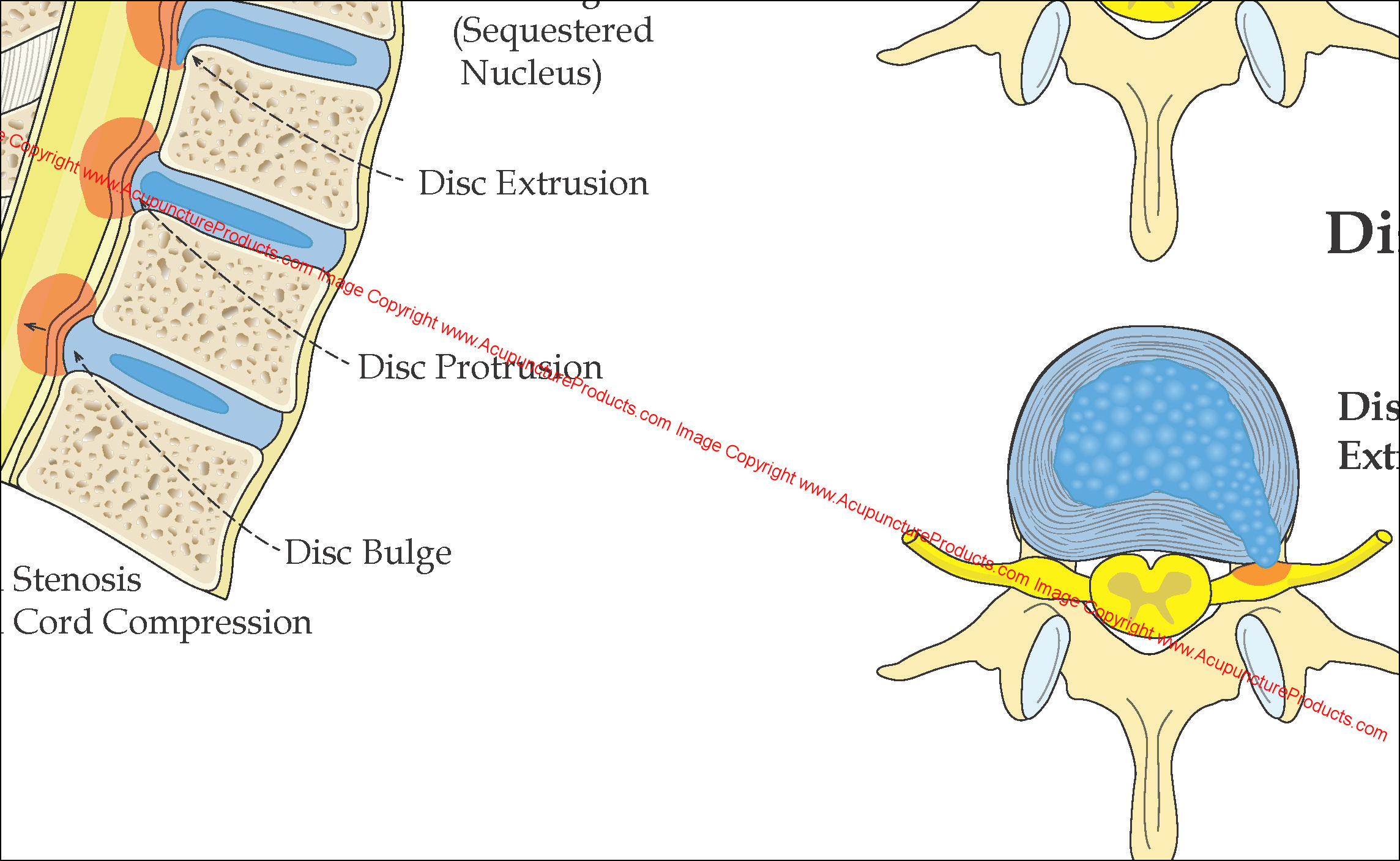 Spinal Intervertebral Disc Herniation