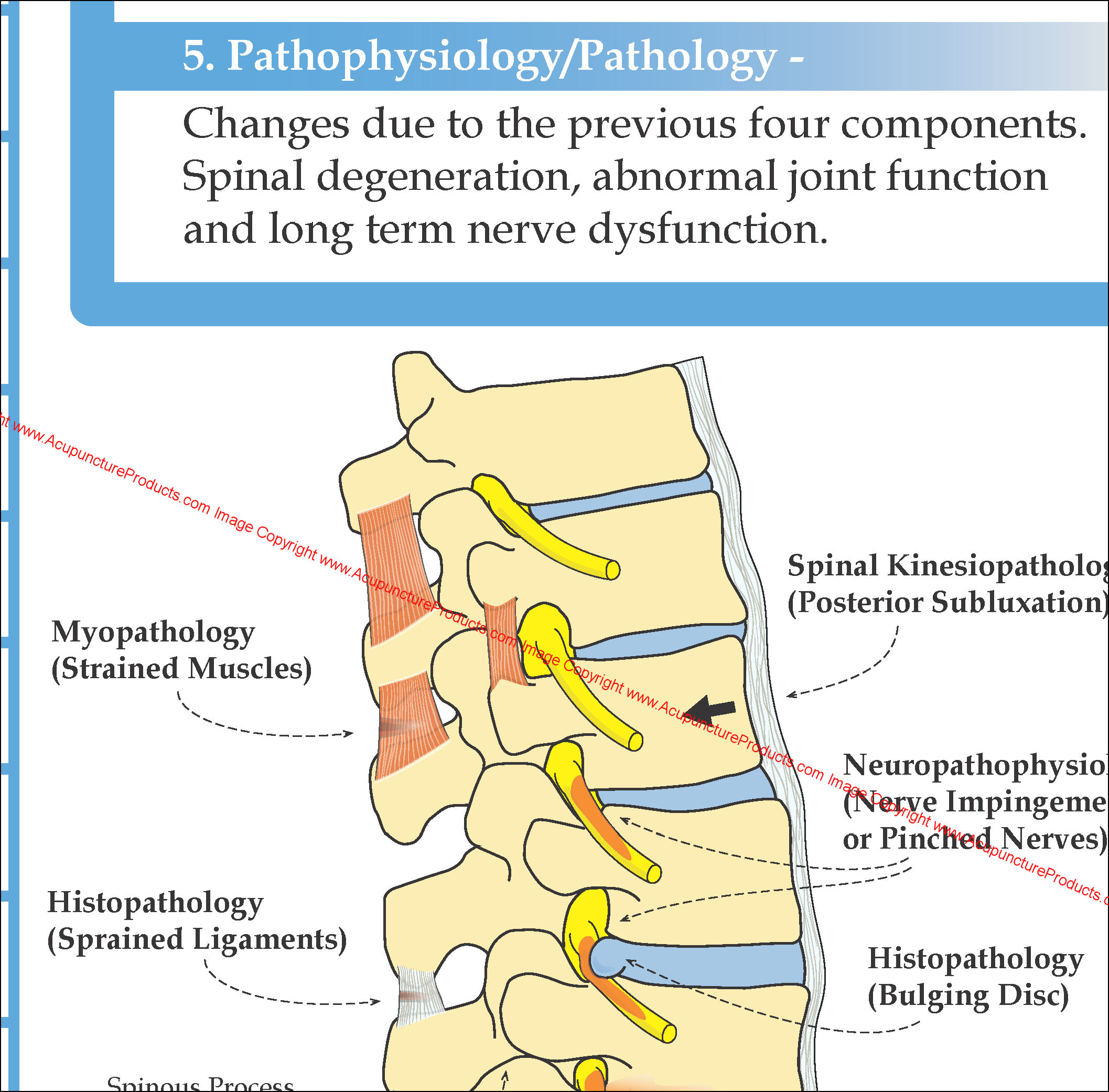 Lumbar Spinal Degeneration