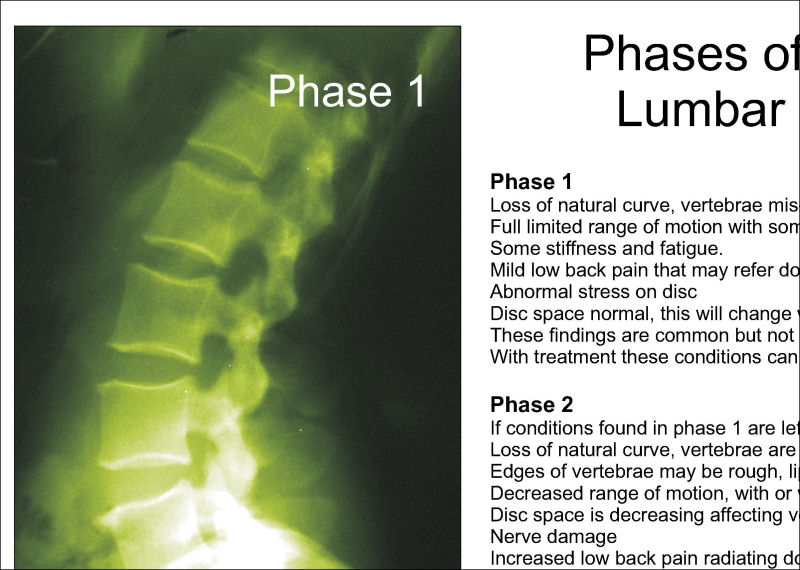 Lumbar Spinal Degeneration Poster