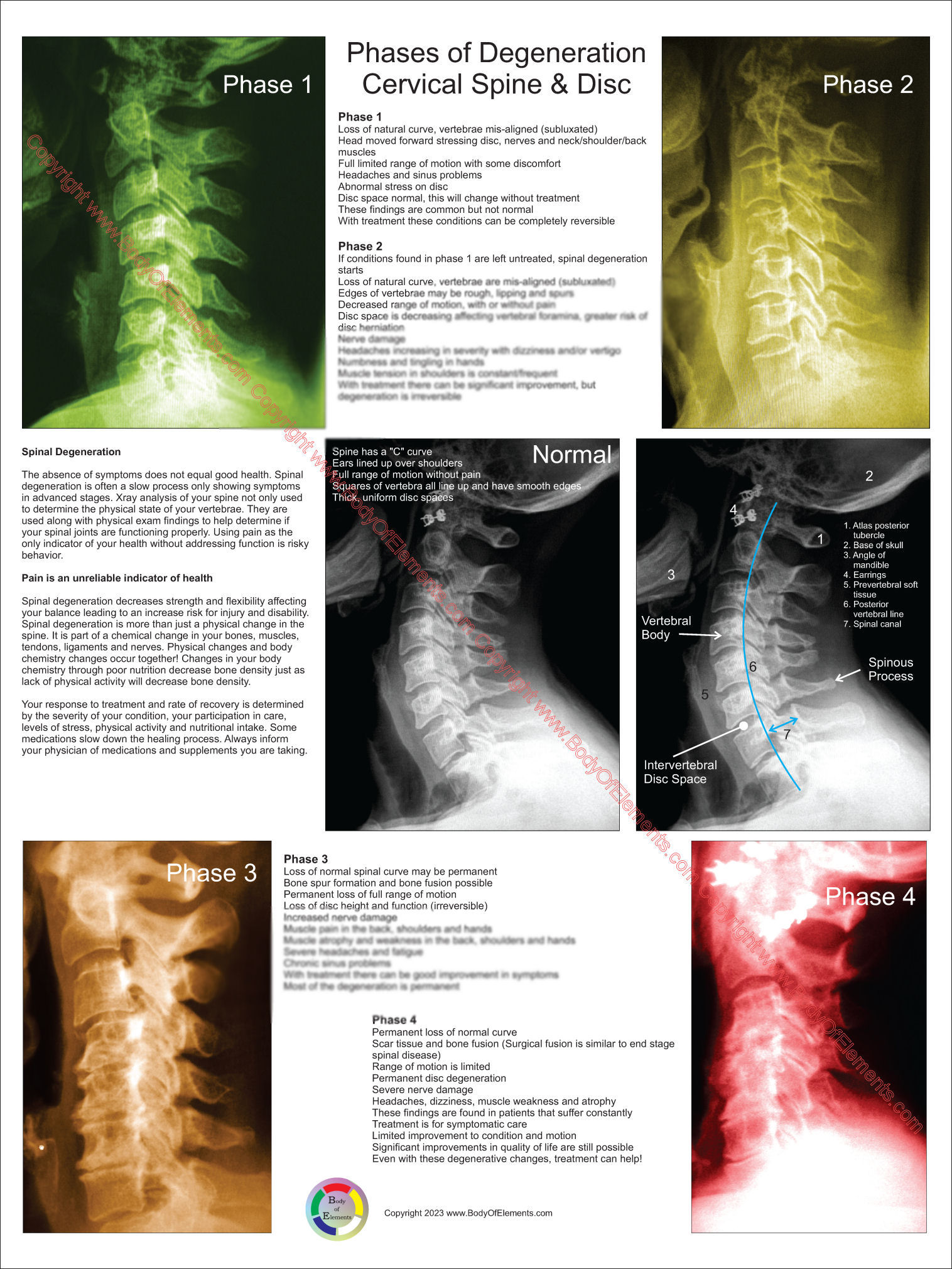 Cervical Spinal Degeneration Poster