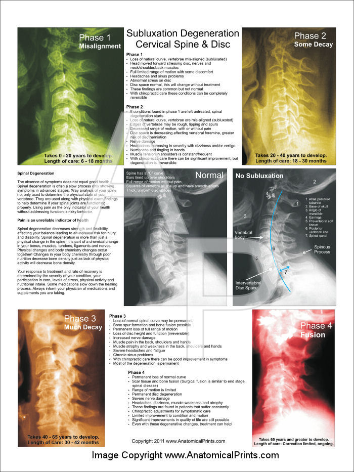 Cervical Subluxation Degeneration Poster