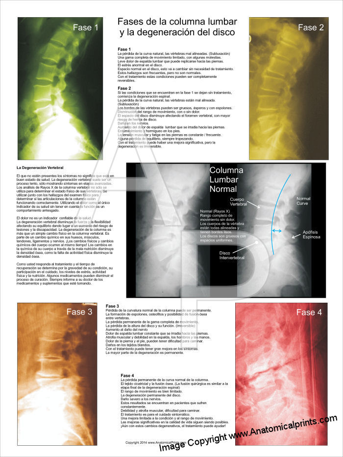 Lumbar Spinal Degeneration Poster