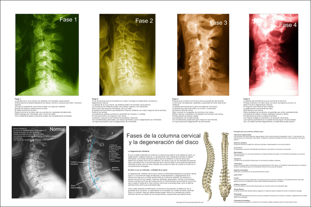 Spinal Degeneration Poster