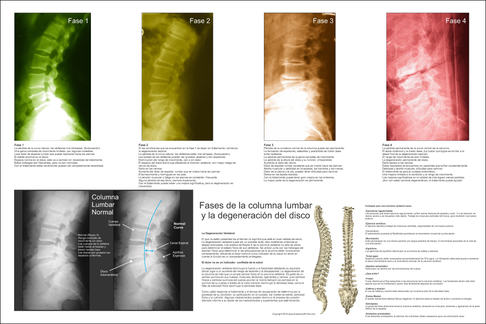 Lumbar Spinal Degeneration Poster