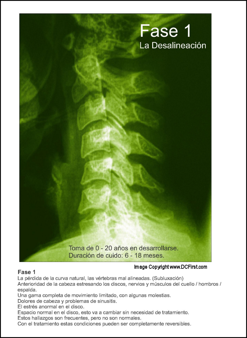 Subluxation Degeneration Poster